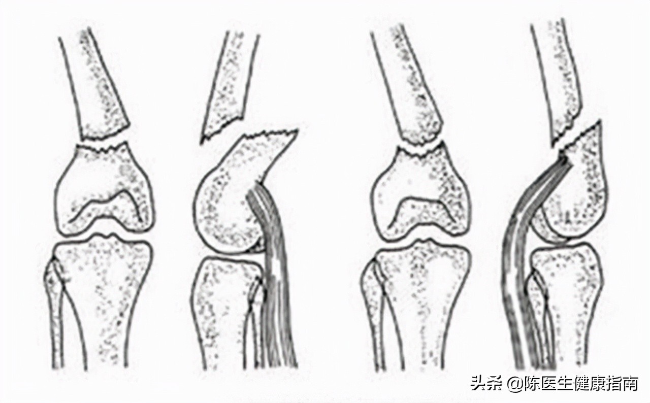 降糖药对糖尿病血管病变的利与弊,适合高血压病人吃的降糖药