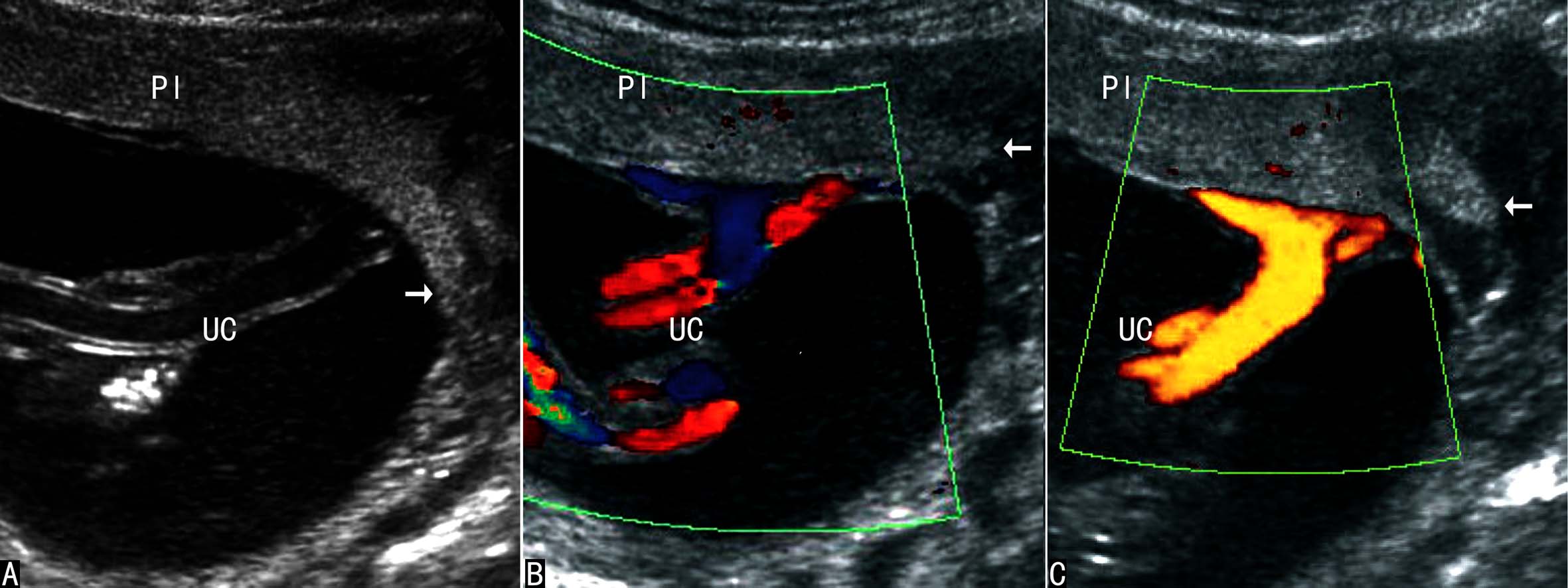 做彩超可以看出来脐带多长吗,超声检查脐带绕颈一圈正常吗