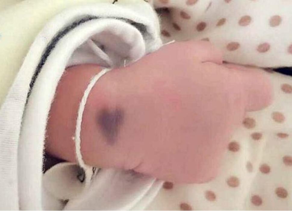 新生儿手臂上有淤青是什么原因,宝宝身上多了淤青什么引起的