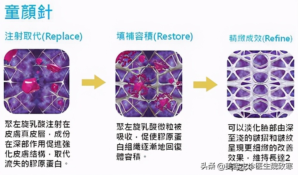 魏致寒：“童颜针到底是什么？最全的科普文章！”