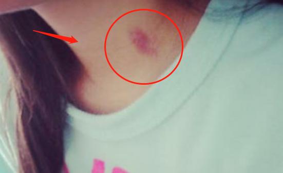 13岁女孩脖子上有“草莓印”，妈*逼妈**问下，孩子的回答引深思