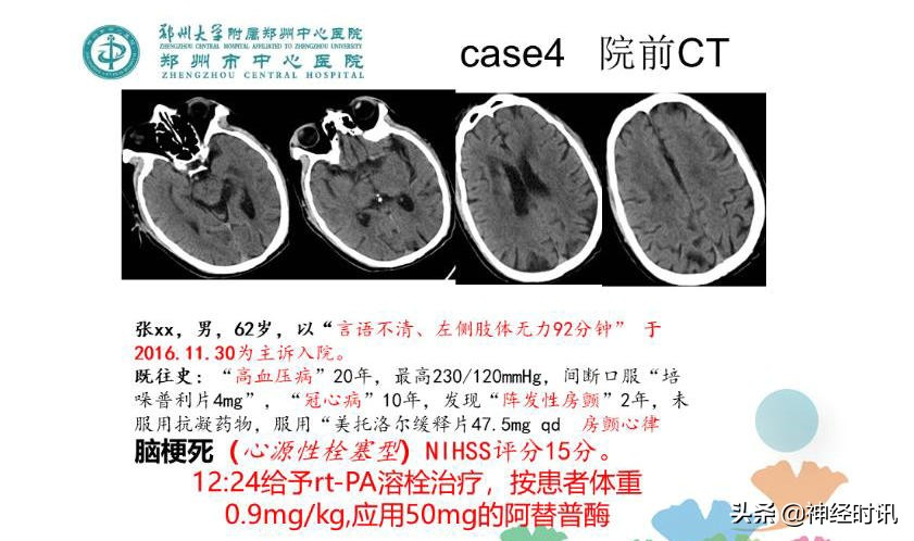 静脉溶栓怎么引起的,静脉相关并发症的预防及处理