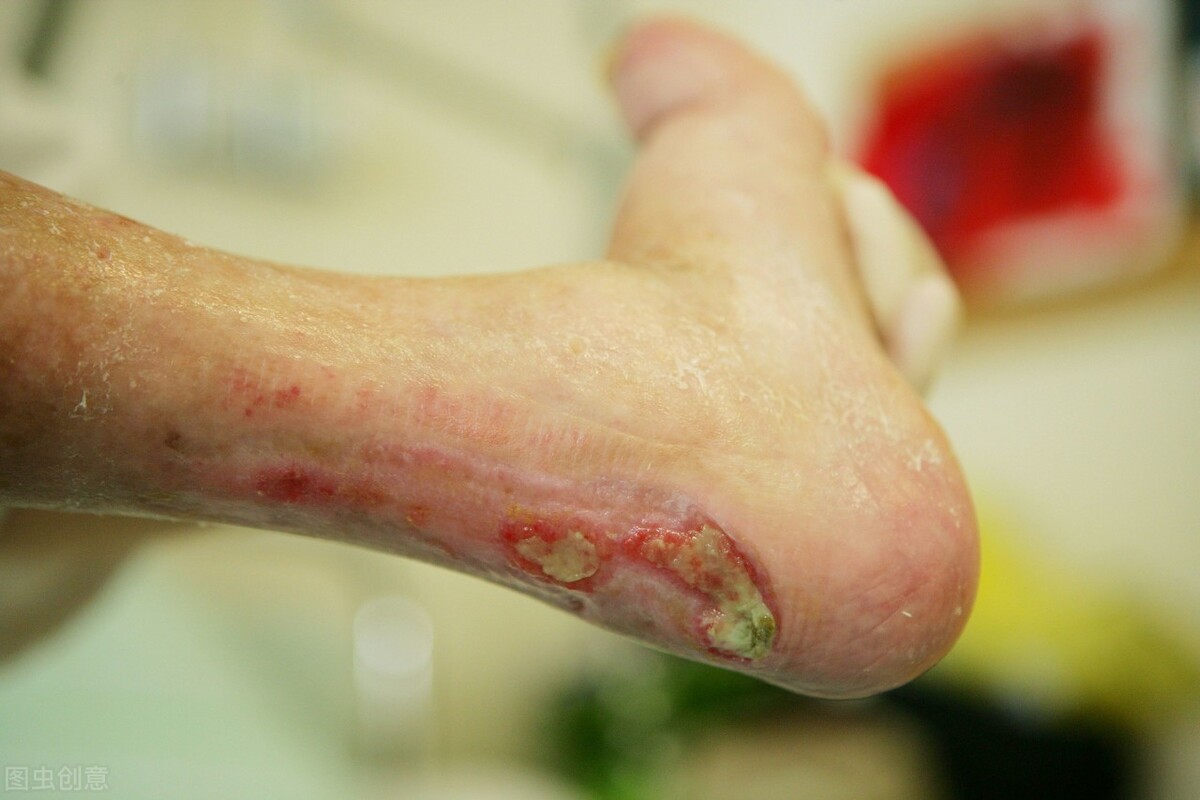 蒙脱石散可以外用治红屁股溃烂吗,蒙脱石散的副作用到底有多可怕