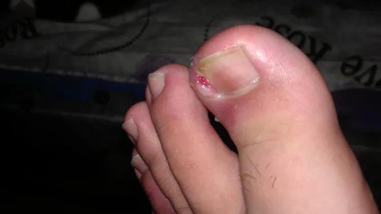 儿童怎么预防甲沟炎,美甲能预防甲沟炎吗