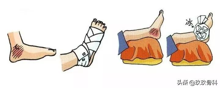 脚踝扭伤一个月后康复训练法,脚踝扭伤是否需要康复训练