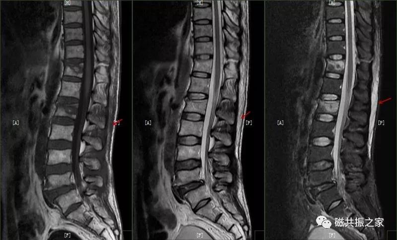 腰椎有哪些病变,腰椎病变有几种