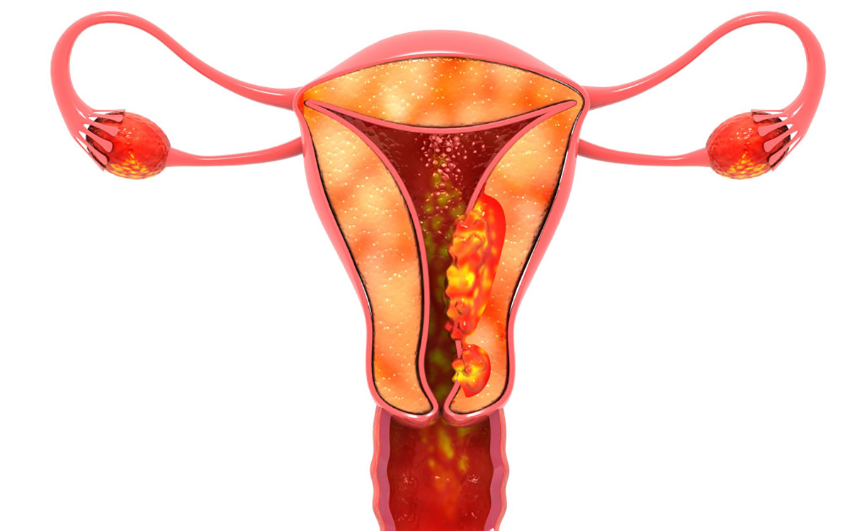 感染hpv病毒后如何防止进一步发展,hpv疫苗预防所有hpv