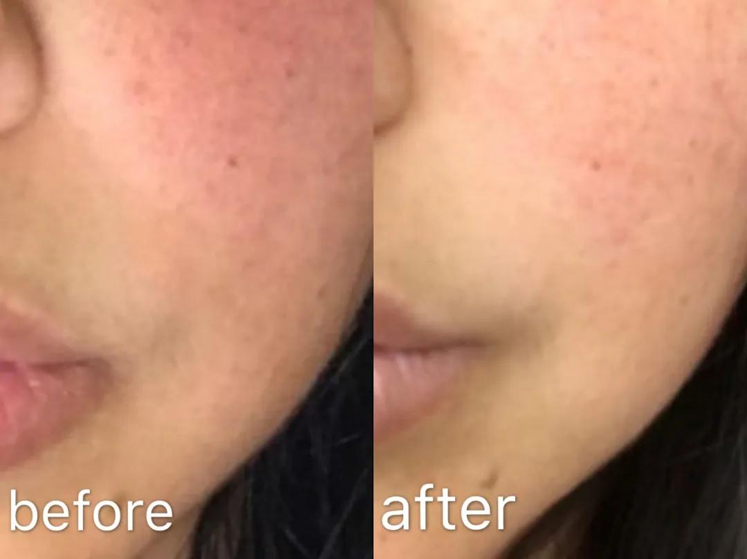 十年战痘肌自救指南,十年痘肌怎么抗痘