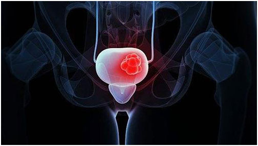 尿频尿急血尿是尿毒症吗,尿频血尿是尿路感染还是妇科炎症