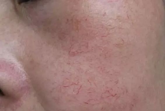 红血丝皮肤护理方案话术,红血丝肌肤的护理方法