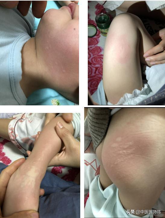 儿童慢性荨麻疹不治疗会自愈吗,儿童慢性荨麻疹治疗不吃药就复发
