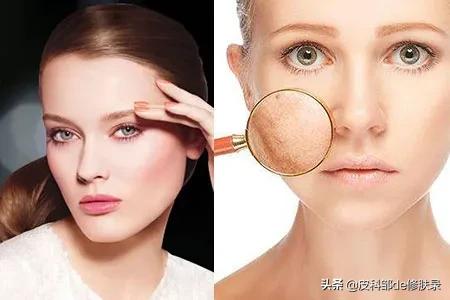 皮秒激光祛斑后的注意事项,做激光祛斑后要忌口吗