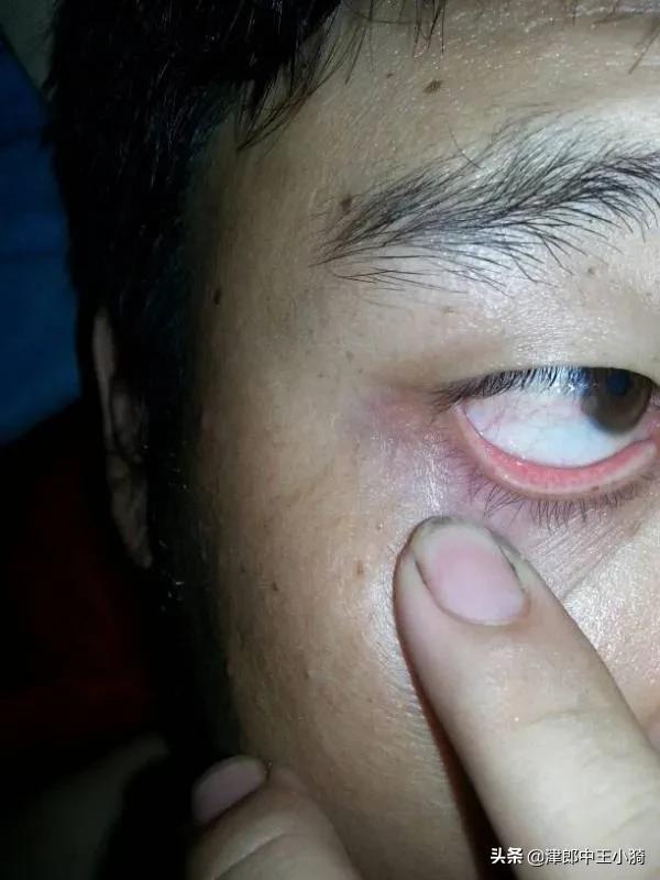 眼睛碰伤了可滴氯霉素眼药水吗,眼睛被划了可以用碘酒吗