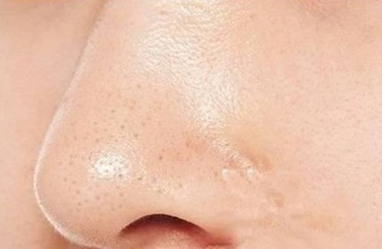 最快解决口腔溃疡的小妙招,口腔内侧有黑头怎么办