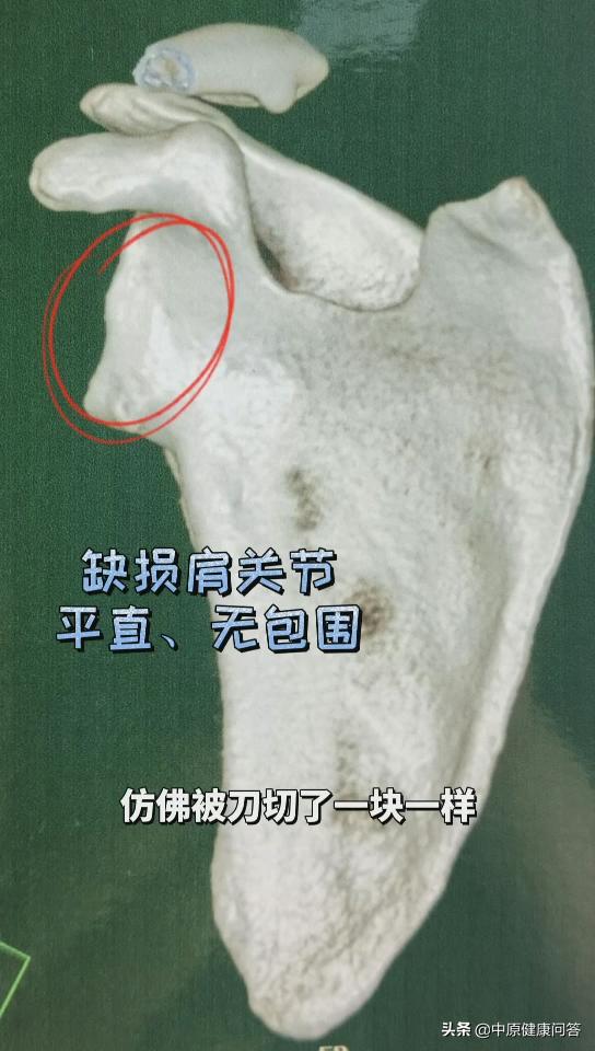 男孩脱臼复位,打篮球手指脱臼当场复位