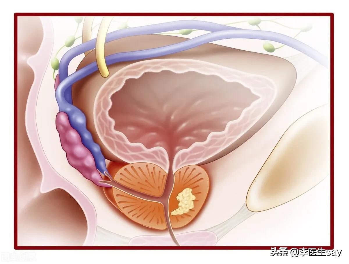 前列腺钙化是什么意思是好是坏,中医专家解疑前列腺钙化什么意思