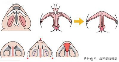 鼻中隔隆鼻的优缺点,鼻中隔软骨隆鼻怎么修复