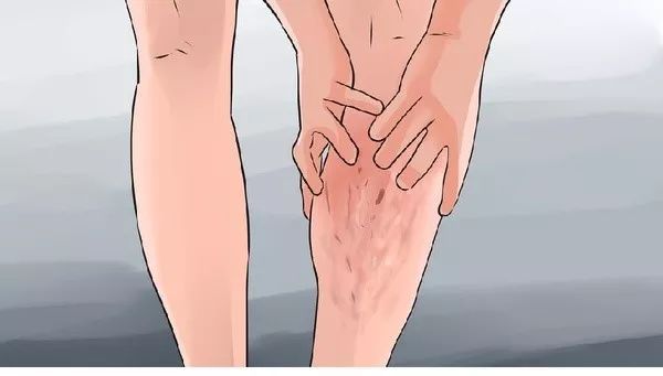 健康小妙招治静脉曲张,下肢浅静脉曲张吃什么中成药