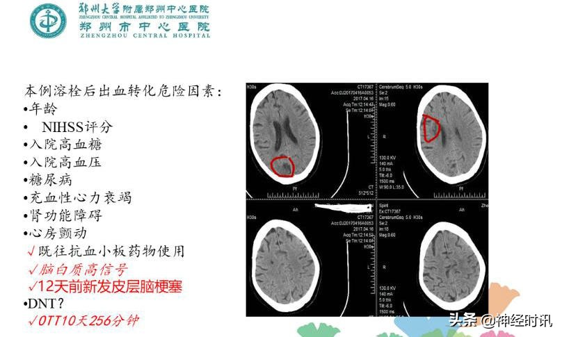 静脉溶栓怎么引起的,静脉相关并发症的预防及处理