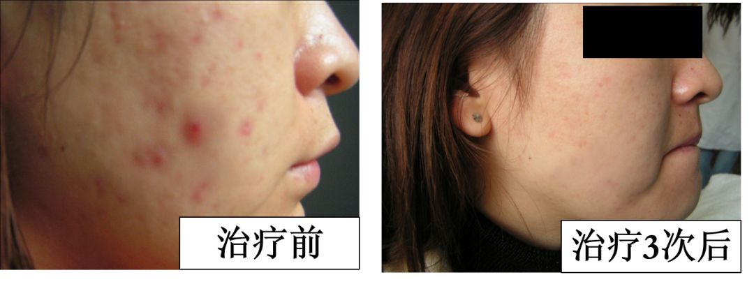 中医火针疗法教学视频,火针操作手法