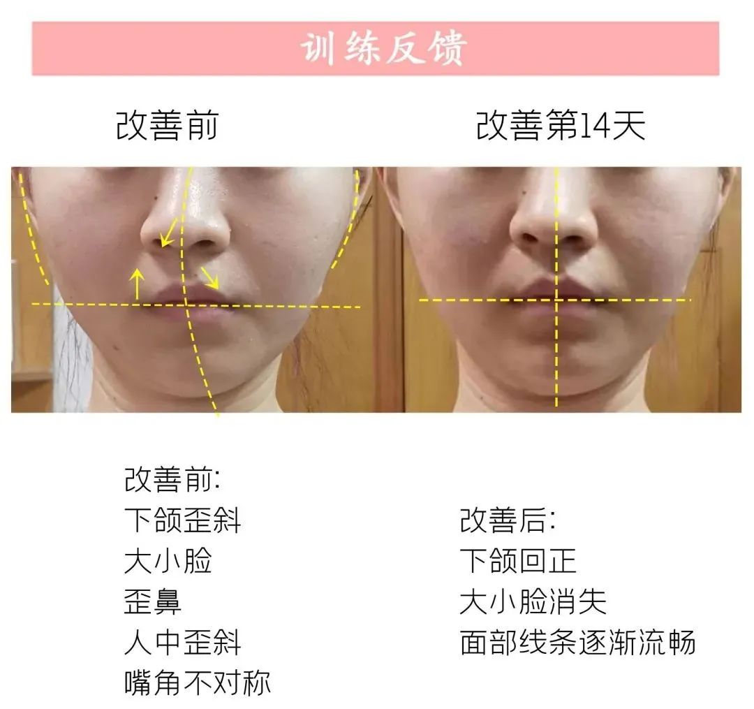 下颌咬合不正导致国字脸,大小脸咬合向左怎么矫正