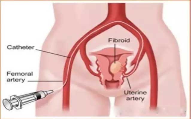 子宫肌瘤腺肌症微创介入科普动画,子宫肌瘤适合微创手术吗