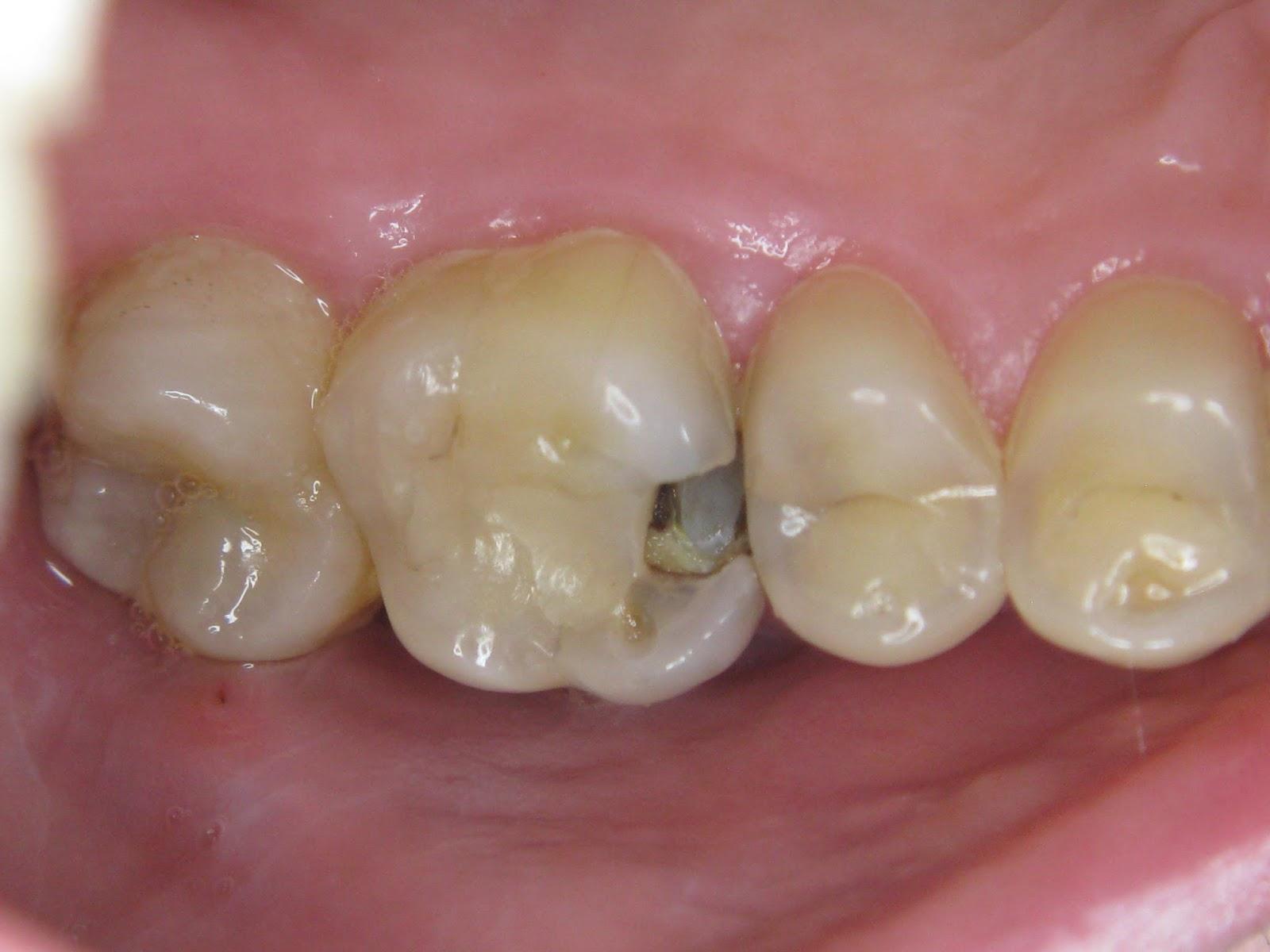 补牙的材料又掉了,补牙用一般材料好还是嵌体好