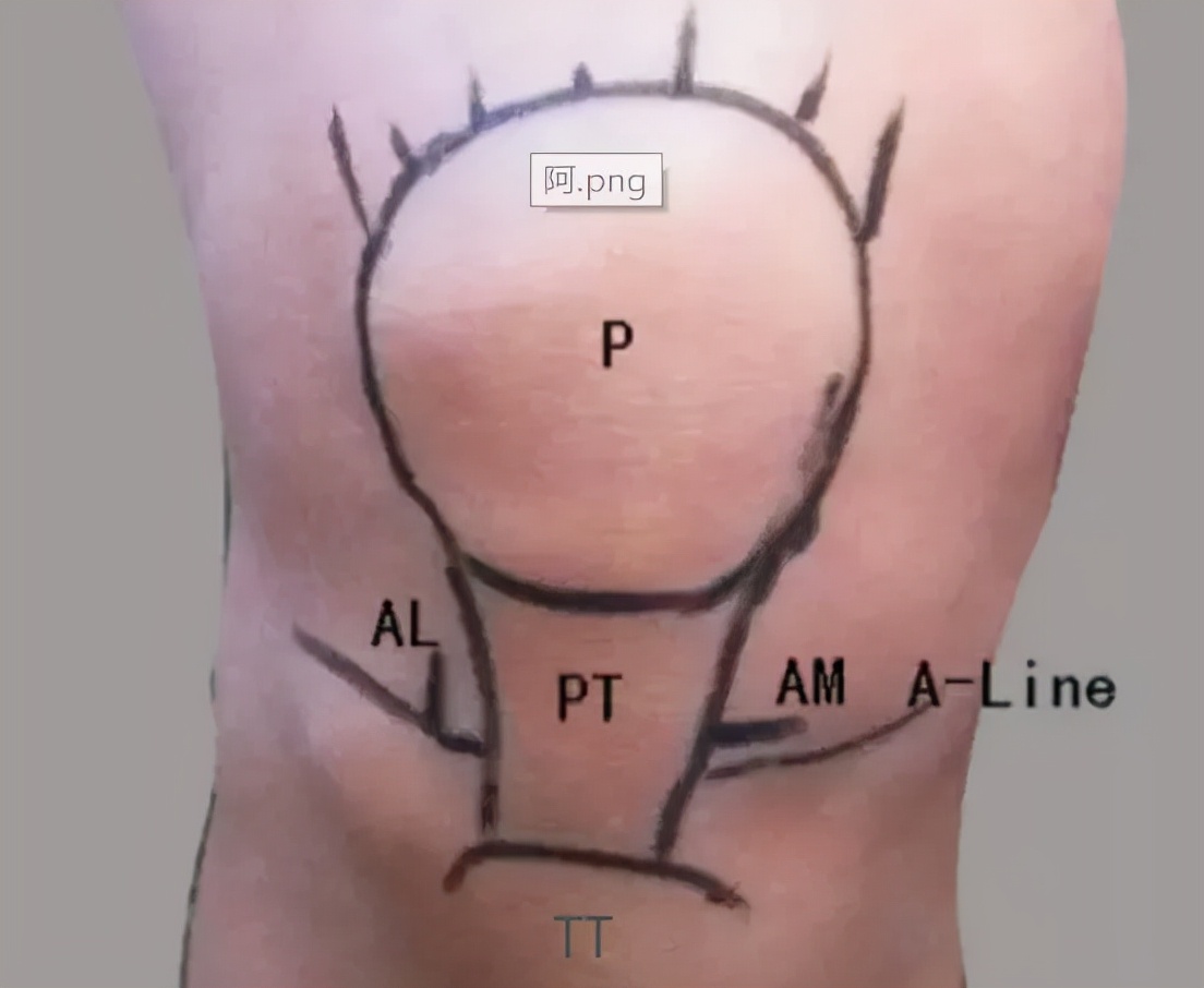 关节镜的适应症是什么,关节镜操作流程及注意事项
