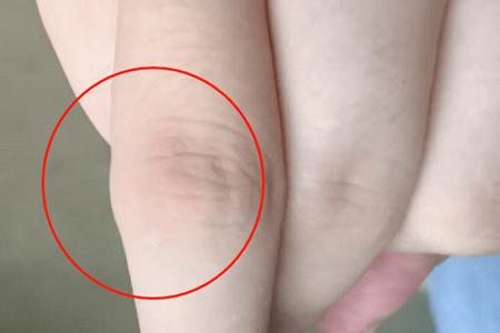 类风湿别瞎折腾,类风湿病病友