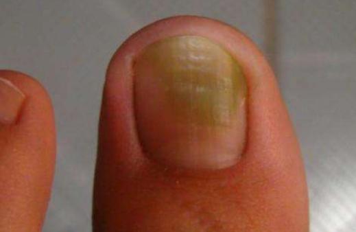 甲沟炎灰指甲脚气的区别,脚气灰指甲甲沟炎挂什么科