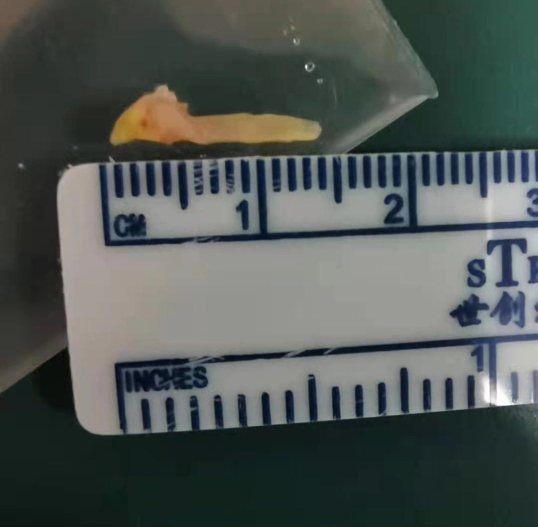 鱼刺卡了又不见了,鱼刺卡了一直没取出来