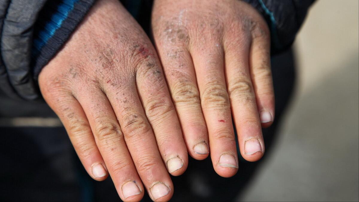 如何告别顽固性冻疮,防治冻疮的小窍门