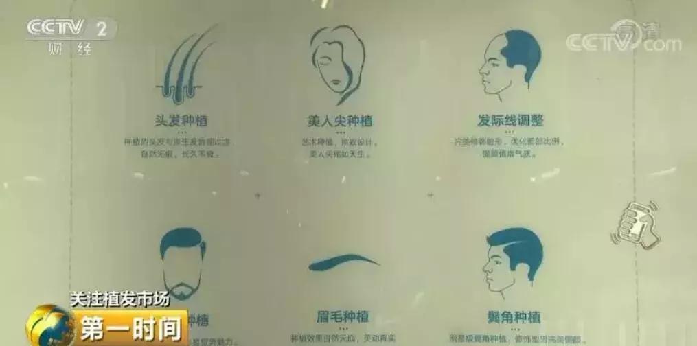 秃如其来视频完整版,秃如其来为哪般