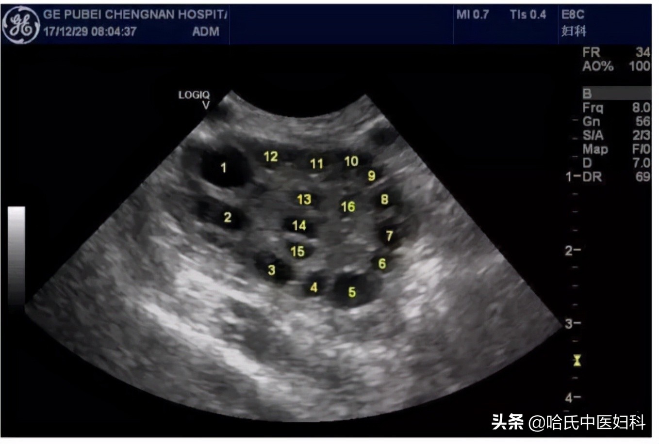 多囊卵巢综合征怀孕多久能测出来,多囊卵巢综合征怀孕了容易流产吗