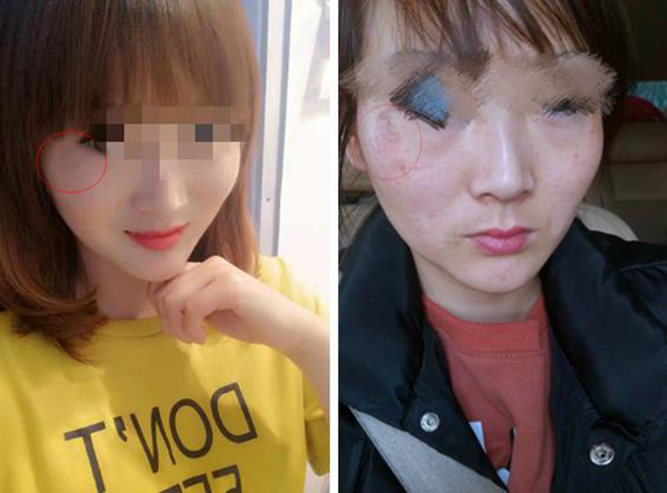 女子祛斑不成反“毁容”,斑美娜涉嫌虚假宣传、未经备案销售