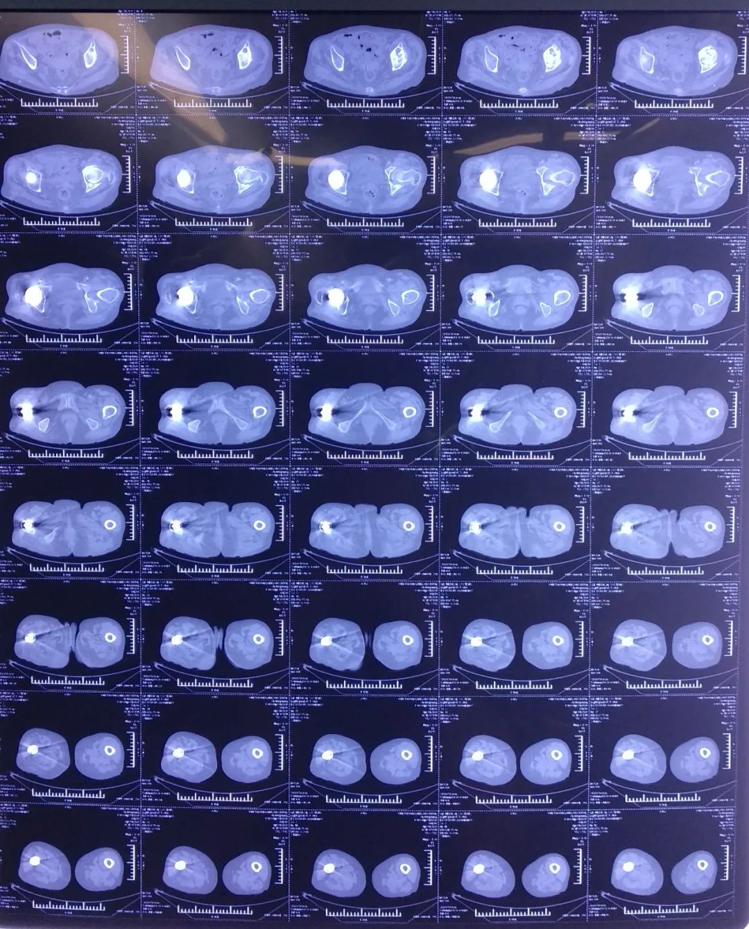 国内全髋关节置换最好的医生,微创全髋关节置换手术与传统置换