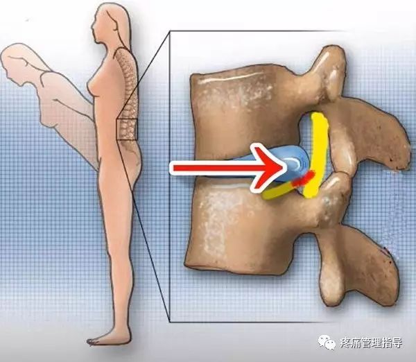 72岁老人腰疼还有骨刺该怎么治疗,老年人骨刺疼痛怎么治疗