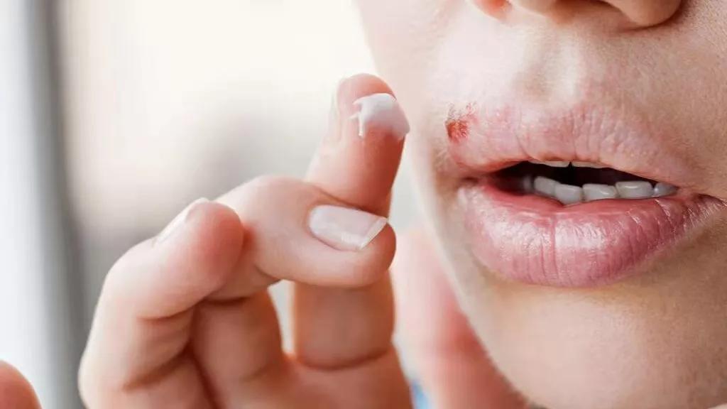 2岁儿童全身长小水泡,2岁小孩一边嘴角长小水泡