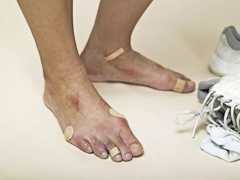 运动防止起水泡,预防长时间走路起水泡