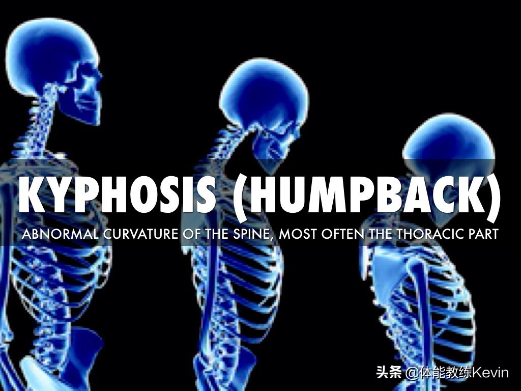 颈椎富贵包的危害有哪些,富贵包的危害及锻炼方法