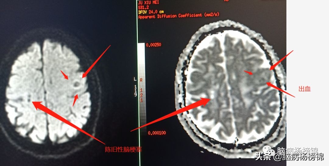 脑出血和脑梗塞同时出现已经昏迷,急性脑梗塞和急性脑出血同时出现