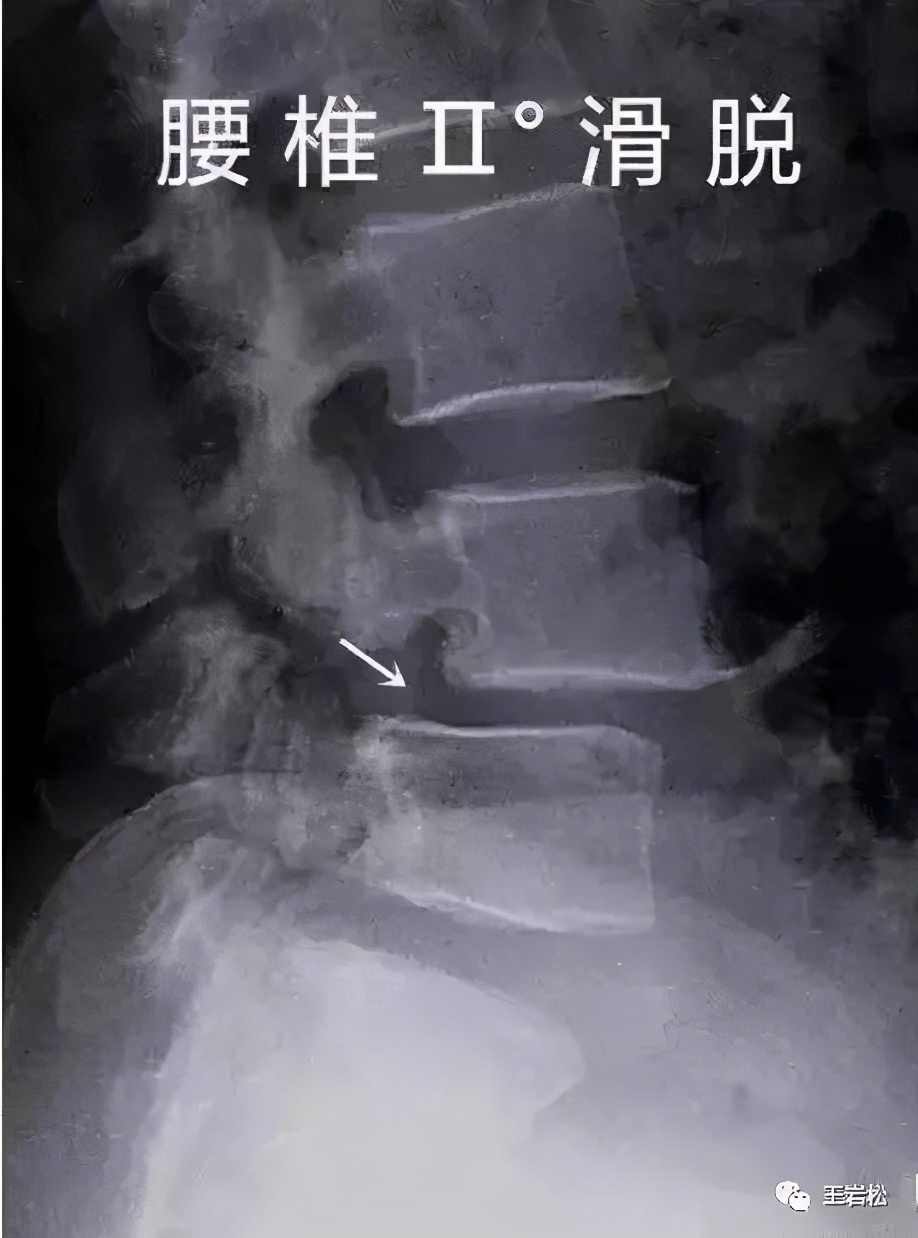 腰椎滑脱症是怎么回事,腰椎滑脱的症状怎么治疗吃啥药