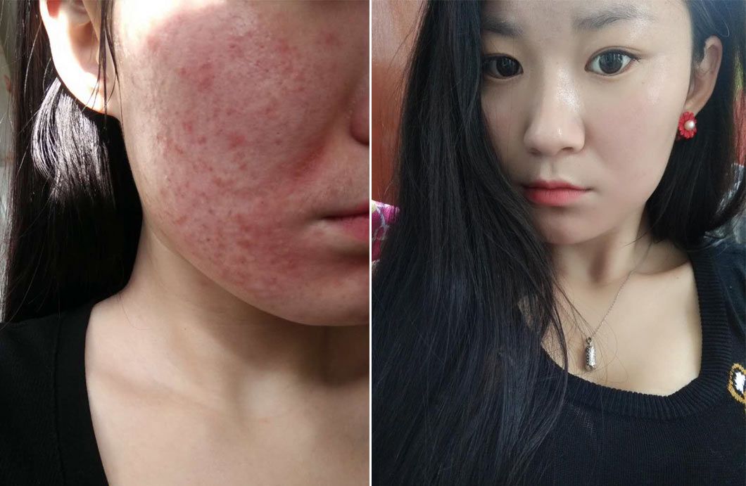 祛痘娇润泉测评真实,祛痘排行榜第一名最良心测评