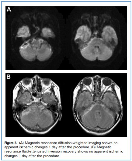 盖延廷大动脉瘤复查,夹层动脉瘤支架治疗
