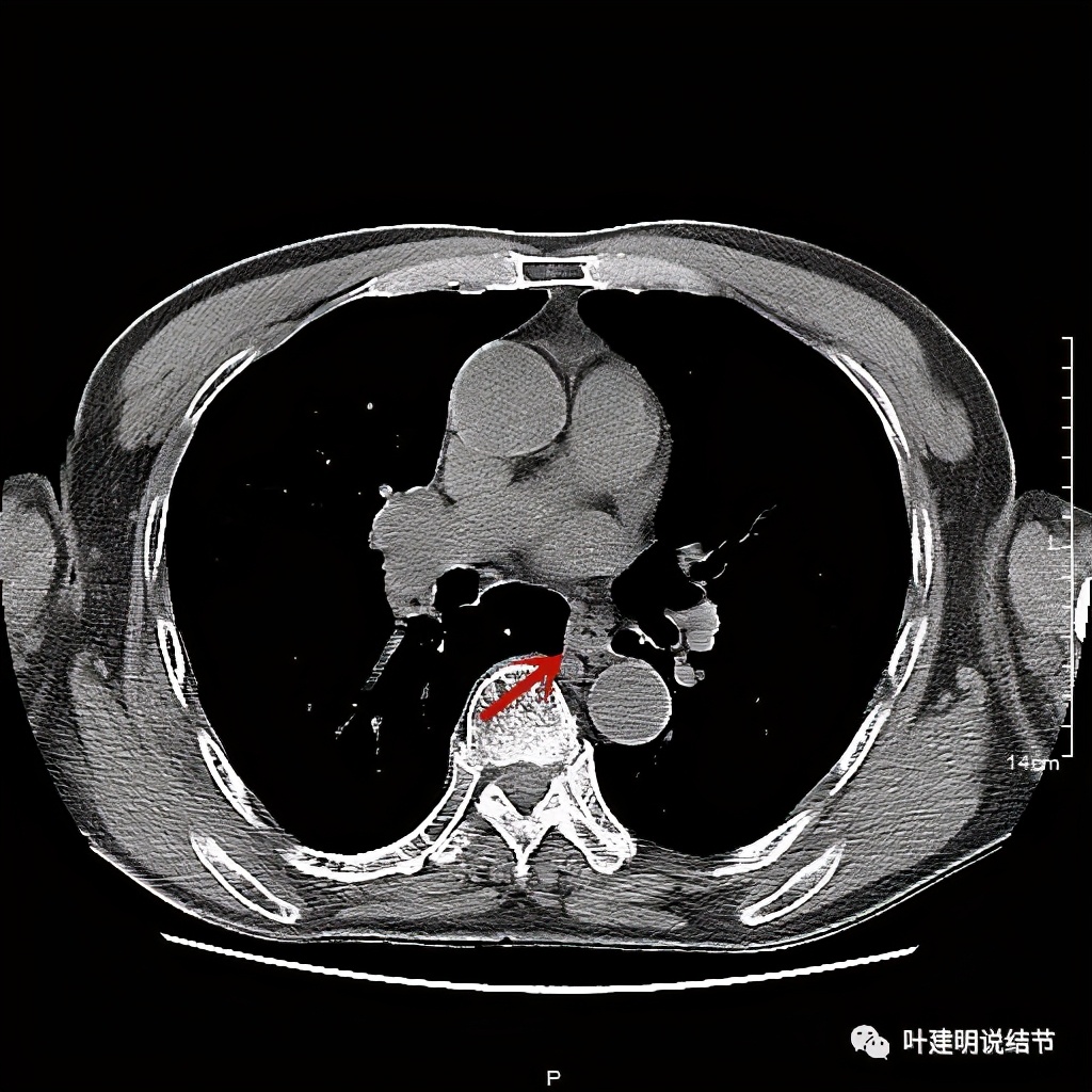 同时患结肠癌和直肠癌怎么办,同时查出了胃癌和肺癌怎么办