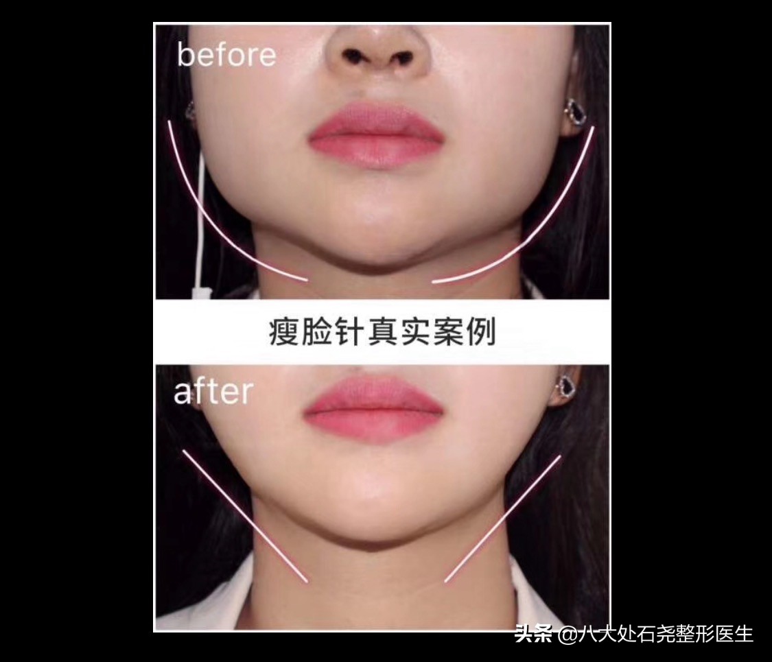 瘦脸针后苹果肌下垂凹陷能恢复吗,你有脸部下垂的烦恼吗