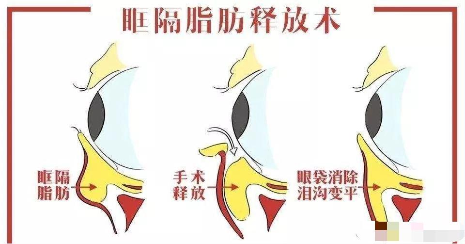 什么是眶隔脂肪释放？为什么很多医生都建议用这个方法去眼袋？