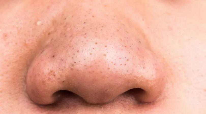 黑头用镊子直接从毛孔拔出来,黑头用镊子直接从毛孔拔出来好吗