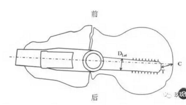 髋部骨折危害大老年人摔伤要重视,髋部骨折的最简单方法