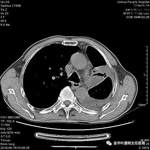 手术引起乳糜胸,有没有做了肺结节手术后是误诊的